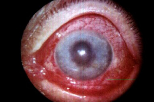 Glaucoma